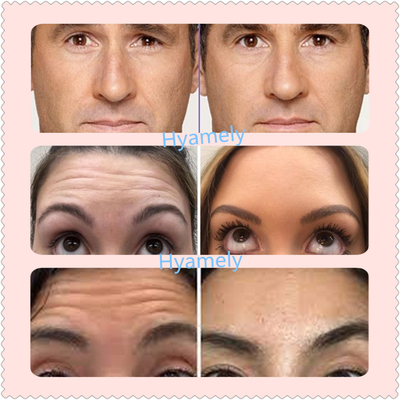 OEM অনুমোদিত Allergan  100 ইউনিট তুর্কি সংস্করণ