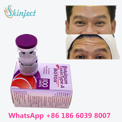 Botulinum Toxin Anti Aging Allergan  On Line Anti Wrinkle কিনুন