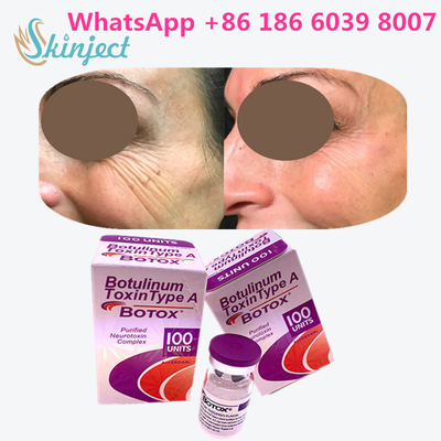 বোটুলিনাম টক্সিন অ্যালারগান বোটক্স 100 Iu 200ui 1 শিশি / বক্স