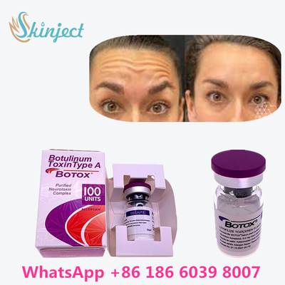বলিরেখা দূর করার জন্য 100% আসল বোটুলিনাম টক্সিন বোটক্স 100u