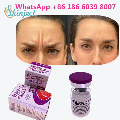 বলিরেখা দূর করার জন্য 100% আসল বোটুলিনাম টক্সিন বোটক্স 100u