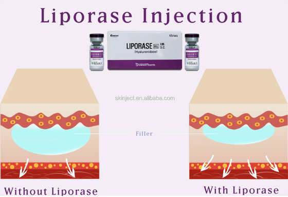 10 Vias Liporase Hyaluronidase ডার্মাল ফিলার দ্রবীভূত করার জন্য