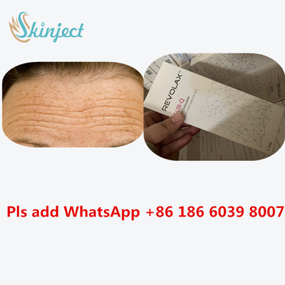 ইনজেকশনযোগ্য ডার্মাল ফিলার রেভোলাক্স 24 Mg/Ml HA হায়ালুরোনিক অ্যাসিড ইনজেকশন