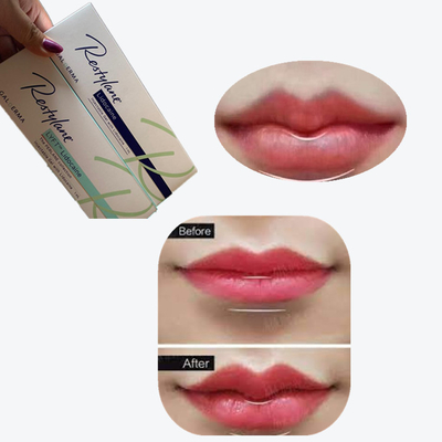 2*1 মিলি/বক্স ক্রস লিঙ্কড ডার্মাল ফিলার