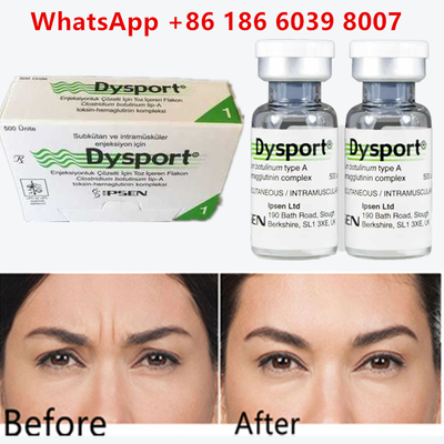 কপালের wrinkles এবং nasolabial ভাঁজ জন্য Botulinum Toxin Dysport