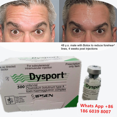 Dysport Botulinum Toxin Type A Anti-Wrinkle Injection for Apple-shaped cheekbones