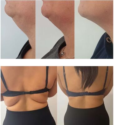 লেবু বোতল ফ্যাট ডিসলভিং ইনজেকশন লাইপোলাইটিক সলিউশন