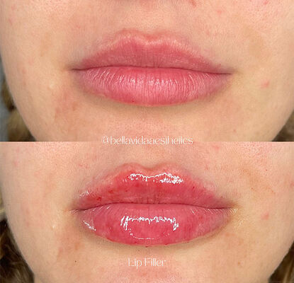 ত্বকের ফিলার ইনজেক্টেবল জেল, যা বলিরেখা কমাতে, মুখের আকৃতি উন্নত করতে এবং ত্বকের পুনরুজ্জীবনে ব্যবহৃত হয়, এর মেয়াদকাল ২ বছর