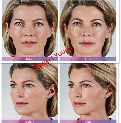 Juvederm Voluma 2x1ml Hyaluronic Acid ইনজেকটেবল জেল ফিলার