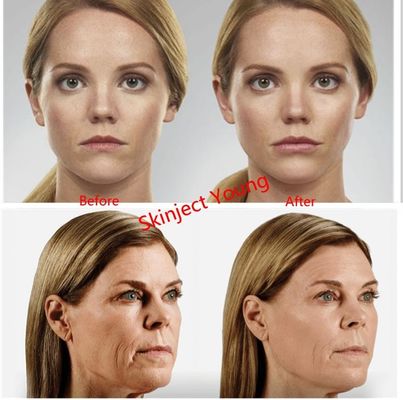 Juvederm Voluma 2x1ml Hyaluronic Acid ইনজেকটেবল জেল ফিলার