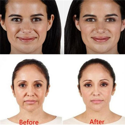 কপাল চোখের বলি জন্য Juvaderm Voluma Hyaluronic Acid Pen Filler