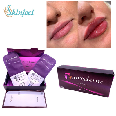 নাসোলাবিয়াল ফোল্ডস লিপস 2x1ml ডার্মাল ফিলার হায়ালুরোনিক অ্যাসিড জুভেডার্ম আল্ট্রা3