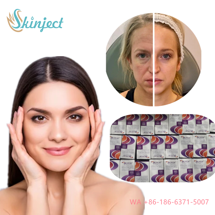 Allergan Botox Nobota 100u 200u for Effective Treatment of Frown Lines Botulinum Toxin Injections